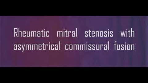 Rheumatic mitral stenosis