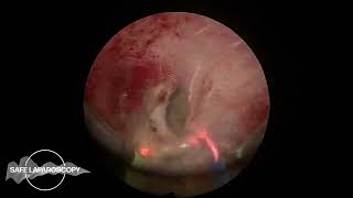 Hysteroscopic Resection of an Adenomyoma