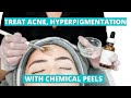 Effective Treatment For Acne, Hyperpigmentation And Discoloration | Chemical Peels