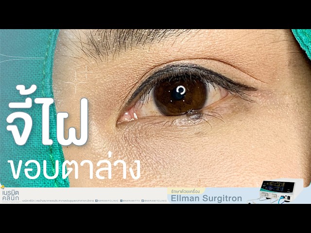 จี้ไฝขอบตาล่าง ใกล้ตาแค่ไหนก็ปลอดภัย ด้วยเครื่อง Ellman Surgitron | เนรมิตคลินิก โคราช EP.339