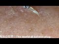 【No.13】角栓連続抜き!Keratin plug mass excl.