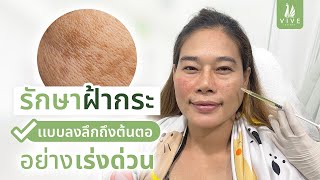 รักษาฝ้า I EP.2 How to รักษาฝ้ากระ ให้กลับมาความมั่นใจในใบหน้าอีกครั้ง l The Vive Clinic