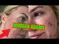 MORGAN ADAMS burns FACE OFF SUES hailey bieber rhode skin