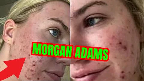 MORGAN ADAMS burns FACE OFF SUES hailey bieber rho...