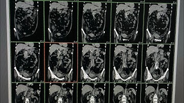 Ncct Kub / Ncct Abdomen/ Kub Filming Ncct Abdomen Filming #ge #ctscan #radiology #filming