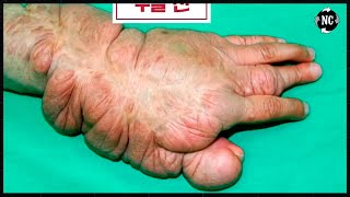 Remember the GARDENER who LIVED RECLUSIVELY because of the 'DUPLICATE ARM'? She has RECOVERED!