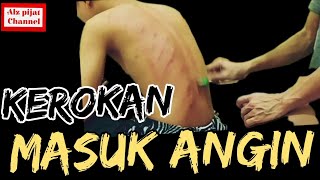 kerokan badan#masukangin