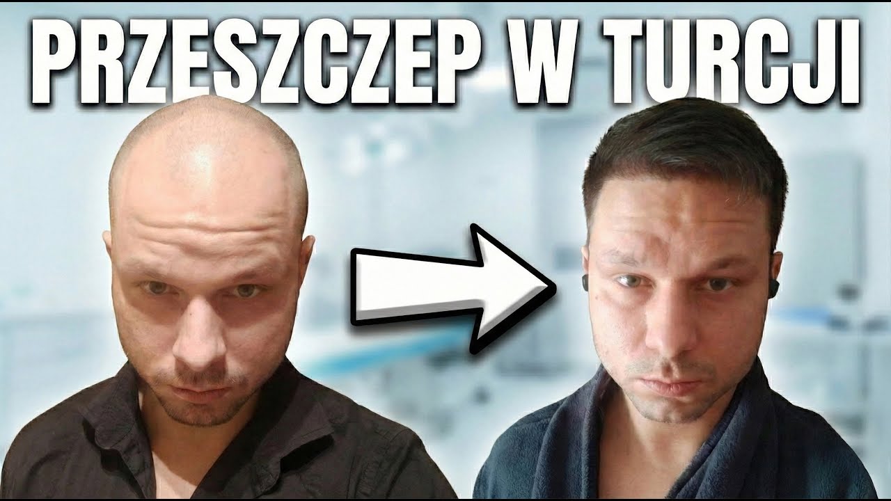 Taki efekt uzyskałem będąc tylko 6 miesięcy po zabiegu