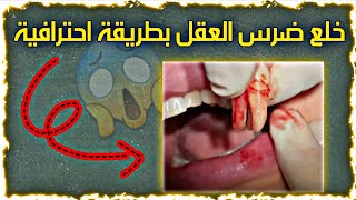 خلع ضرس العقل بطريقة احترافية 🩺🦷