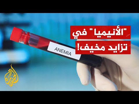 ربع سكان العالم مصابون بفقر الدم!
