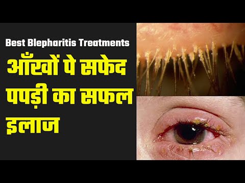 Blepharitis | आँखों पे सफेद पपड़ी का सफल  इलाज