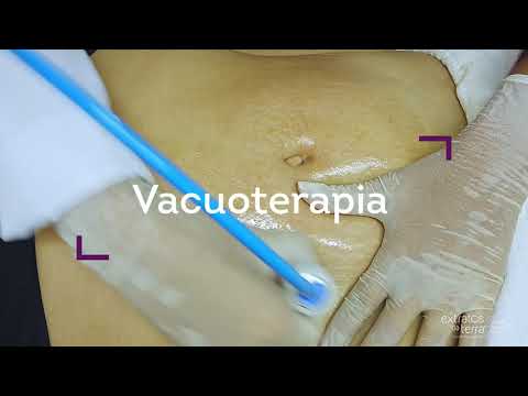 Estrias - Protocolo de tratamento com Microdermoabrasão e vacuoterapia