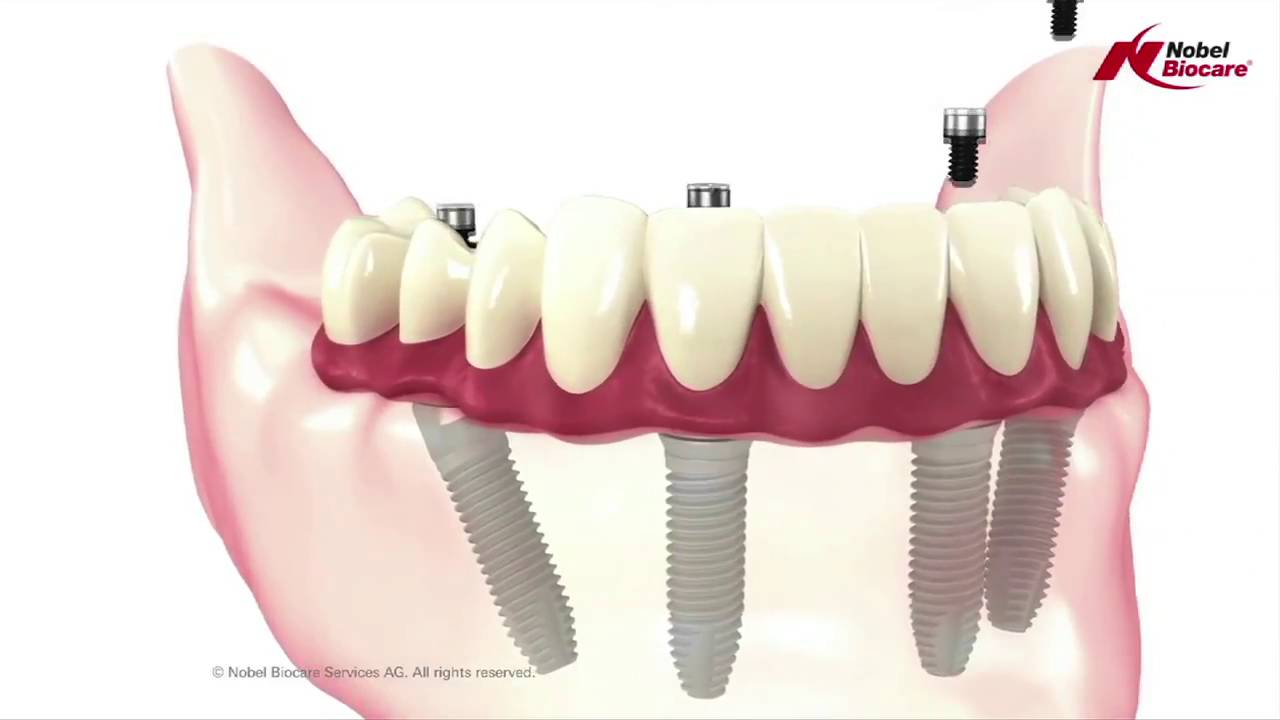 Nobel Biocare Mobile All On 4 Regina Yorba Linda Ca Nobel Biocare Dental Implants