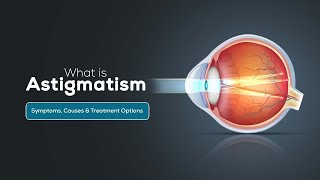 What is Astigmatism: Symptoms, Causes & Treatment Options