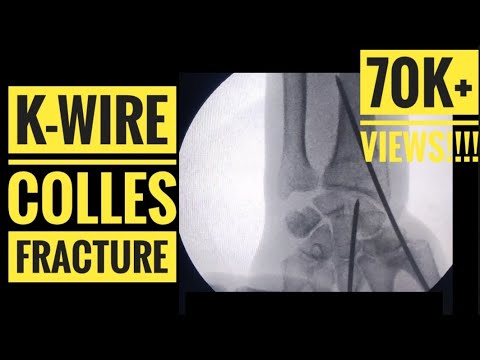 K- wire of