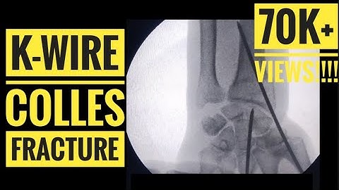 K- wire of Colles/ Distal Radius Fracture