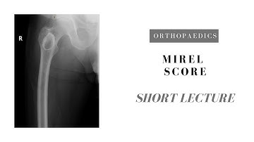 MIREL Score - How to decide when to prophylactically fix a pathological lesion?