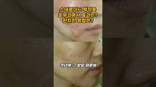스테로이드 부작용이 너무 심할때 바로 해결하는 방법 #스테로이드부작용