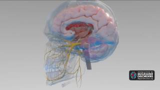 What Causes Migraine Disease? 5 Factors in Migraine Neurobiology