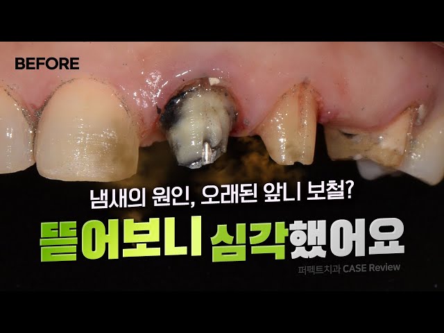 🤢오래된 앞니 크라운, 브릿지 교체 및 라미네이트 | 앞니 보철 16개🦷