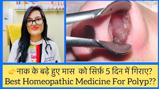 नेज़ल पॉलप? नाक के बढ़े हुए मास का पर्मनेंट इलाज - Nasal Polyp Top Homeopathic Medicine _ Nasal Mass