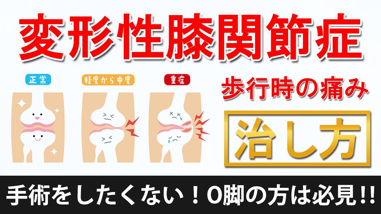 【変形性膝関節症】歩行時の痛み治し方・解消法 O脚の方は必見です