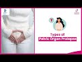 Pelvic Organ Prolapse Stages &amp; Types - Dr.Vinatha Puli at Cloudnine Hospitals | Doctors&#39; Circle