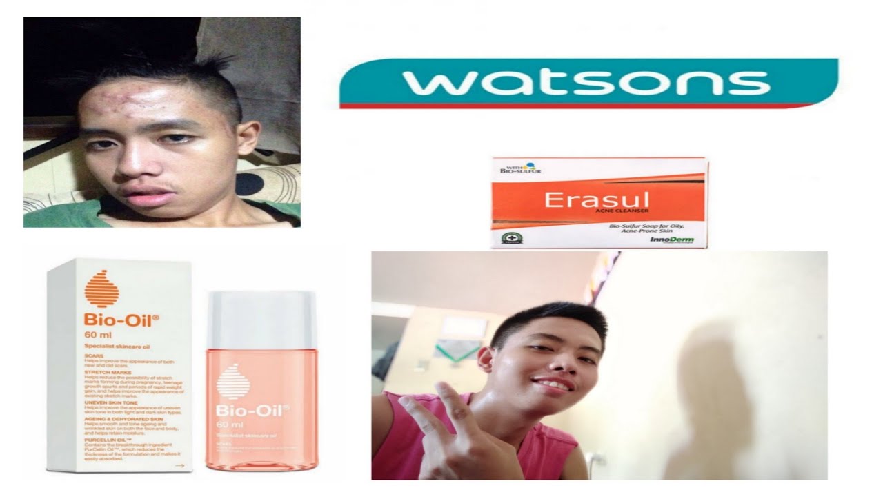 Pimples,scars and acne no more! (WATSONS PRODUCTS) VLOG1 YouTube