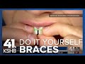 DIY Braces