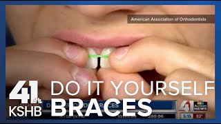 DIY Braces