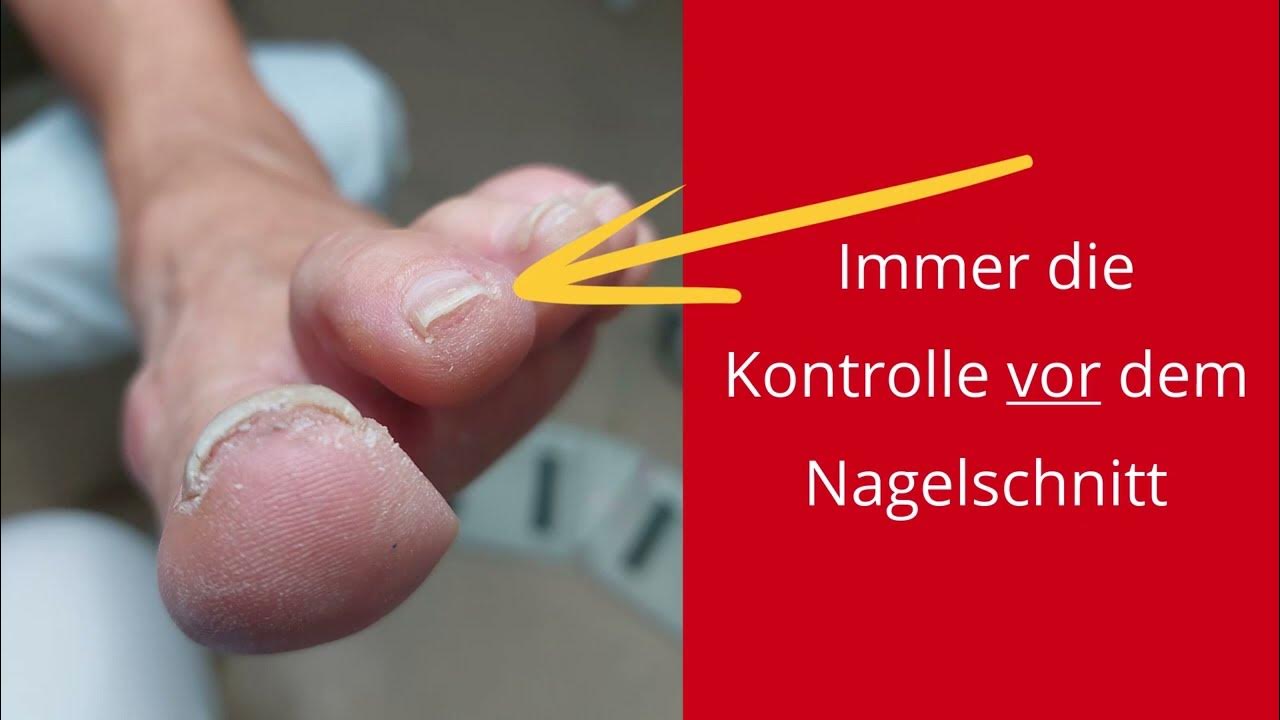 Ihr Nagelbett Ist Angewachsen? Hier Erfahren Sie, Was Sie Tun Können! YouTube