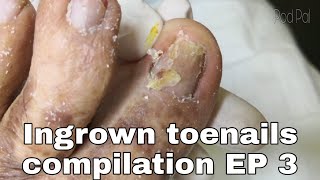 Ingrown toenails 2 cases ,알찬구성 내성발톱 왕건이 모음집, 甲溝炎  EP3