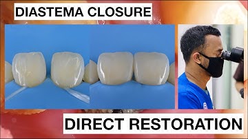 Diastema Closure with Direct Bonding Composite Restoration | General Dentist Griya RR