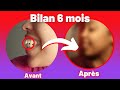 Dents trop avancées ? Mon témoignage (partie 1)