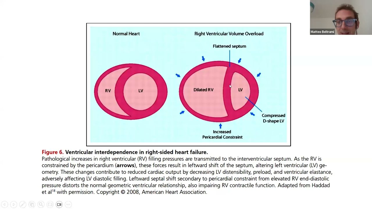 Adattamenti e disadattamenti del cuore destro nello scompenso cardiaco sinistro