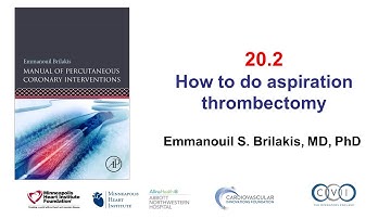 20.2 Aspiration thrombectomy step-by-step: Manual of PCI