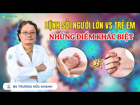 Bệnh sởi NGƯỜI