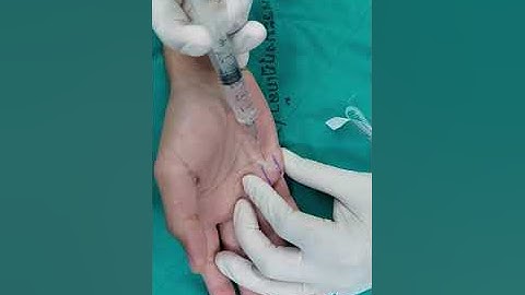 Injection: Digital nerve block - subcutaneous technique (small finger)