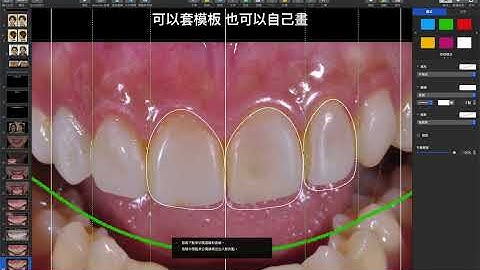 Digitial smile design by Keynote  畫牙齒