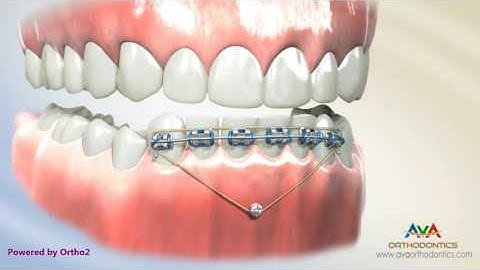 Orthodontic Treatment for Deepbite - Temporary Anchorage Device or TAD
