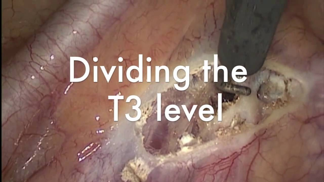 ETS ( Endoscopic Thoracic Sympathectomy )