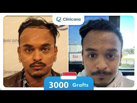Shaon’s hair transplant