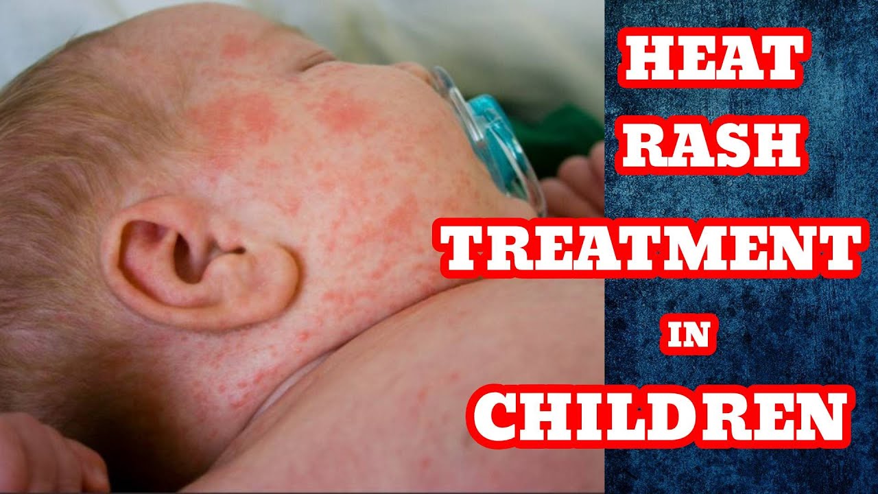 Doctor explains HEAT RASH (miliaria) in a baby  Causes, symptoms,  treatment and prevention 