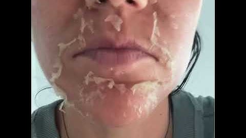 VI peel : before during and after chemical peel results video
