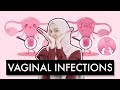 Vaginal Infections