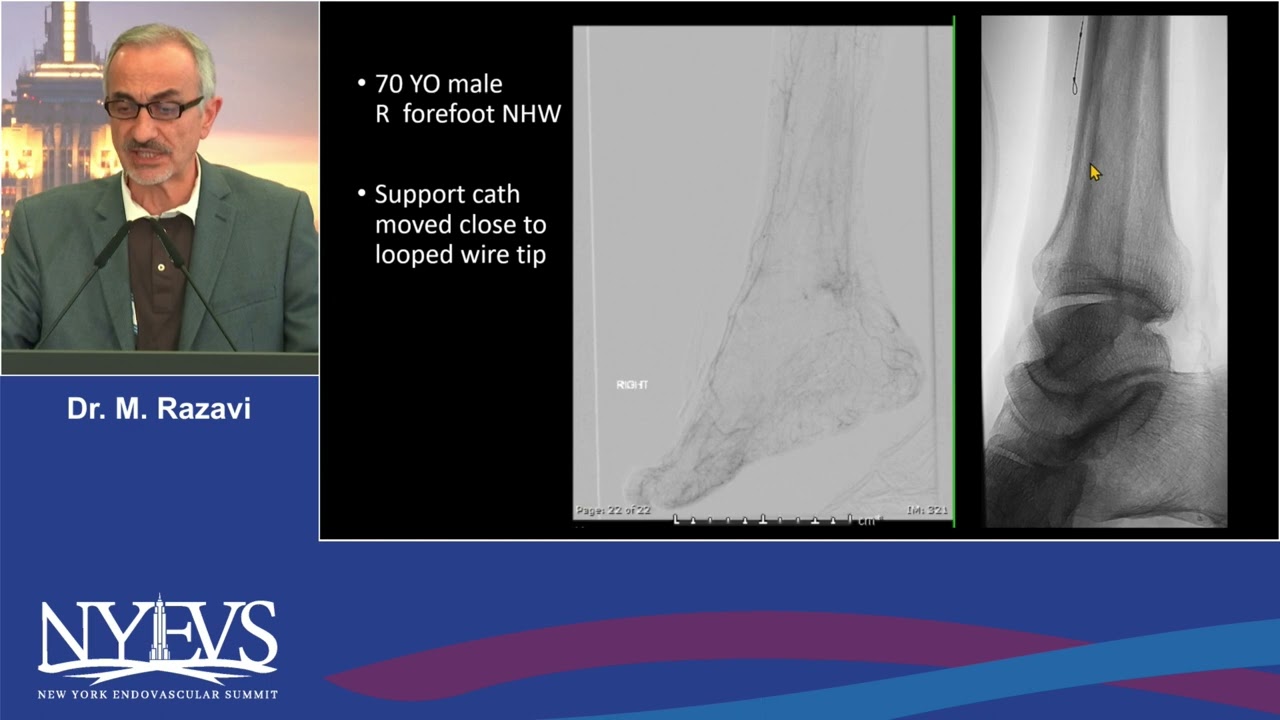 Crossing Techniques for Below the Knee CTO's Is there a Universal Algorithm Mahmood RazaviSession II