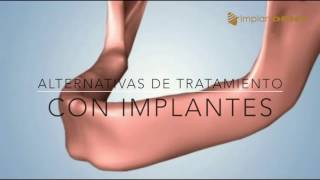 Que hacer si no tengo dientes