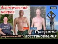 История и результаты восстановления от асептического некроза и здоровья после ковида