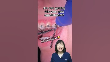 Móc chun chuỗi khi niềng răng | Dr Anh Thư