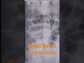 #smallbowelobstruction #saio #paralyticileus #dilated#bowel#loops #case